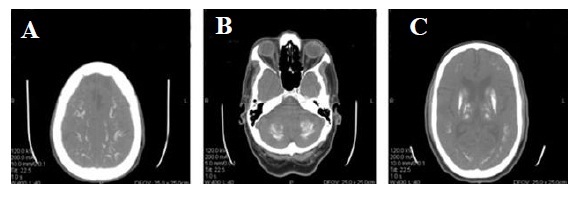 An Elderly Man With Akinetic Movement Disorder
